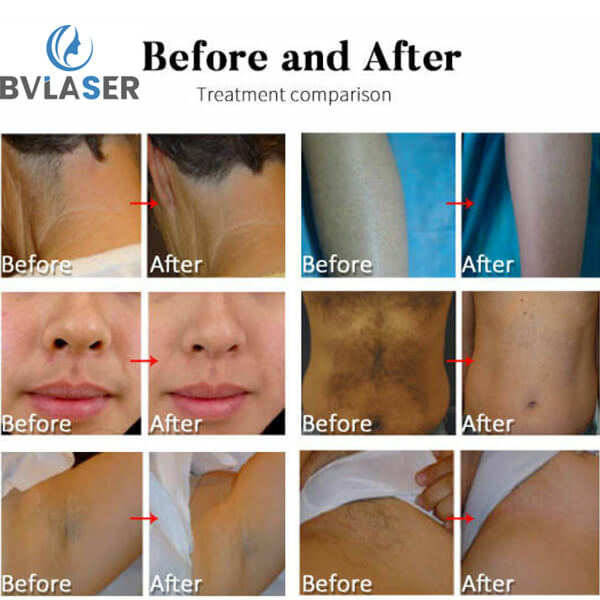 How many sessions need for permanent laser hair removal results?