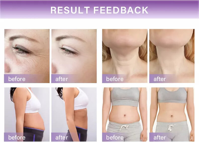 hifu beauty machine treatment before and after