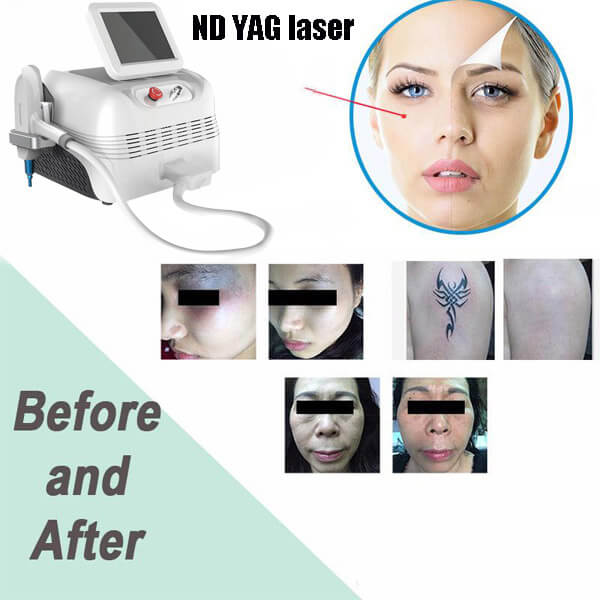 ND YAG laser machine for age spots removal