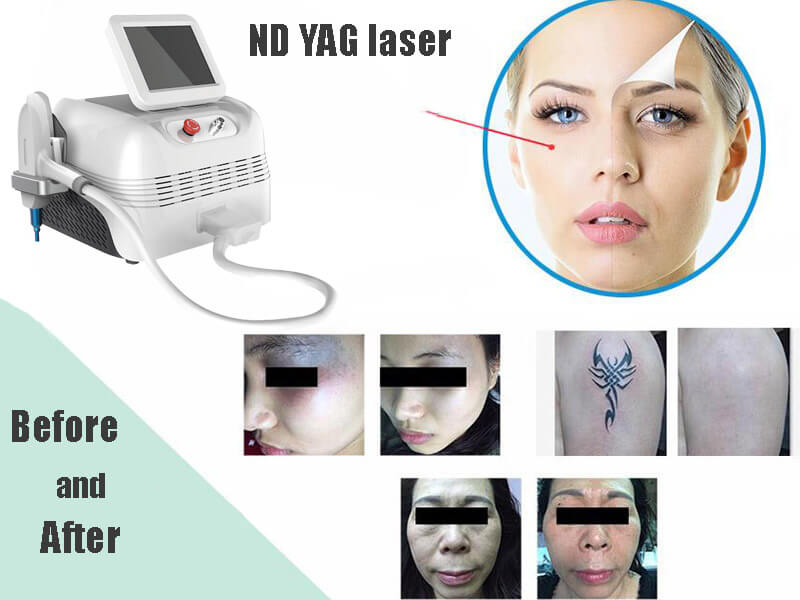 nd yag laser machine