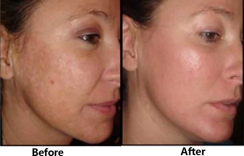 co2 fractional laser treatment before and after