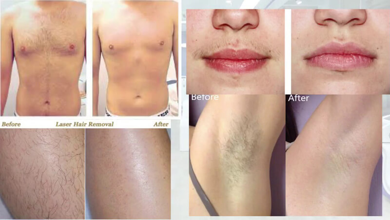 diode laser hair removal treatment