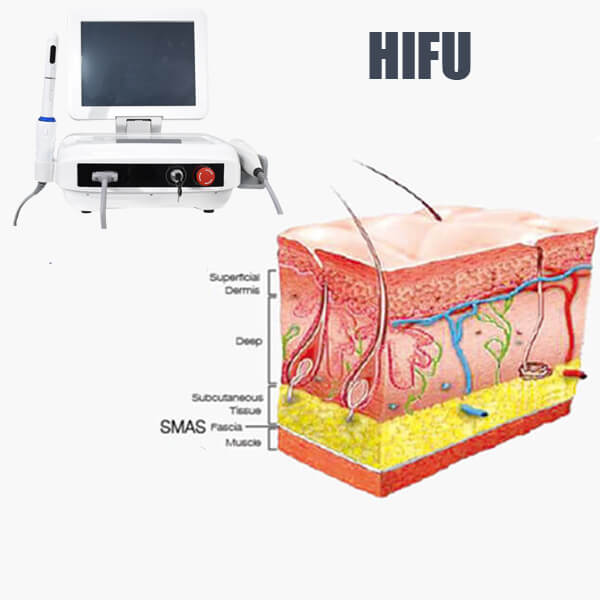 Who can have HIFU treatment and what areas can HIFU treat